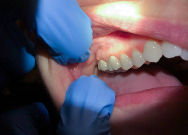 Best Lost Filling or Crown Replacement in Barnesville, OH