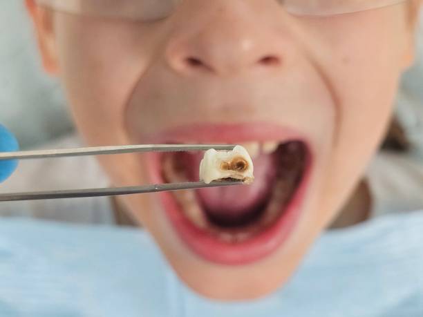 Best Emergency Wisdom Tooth Extraction in Barnesville, OH